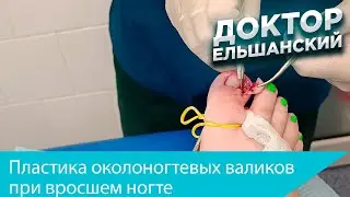 Вросший ноготь, пластика околоногтевых валиков обоих первых пальцев