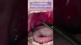 Tonsil irrigation 