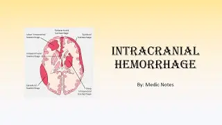 Intracranial hemorrhage - intracerebral vs extracerebral (extradural, subdural, subarachnoid)
