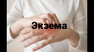 Как лечить экзему по европейским стандартам в России?