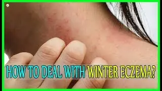 How To Deal With Winter Eczema - How To Stop Eczema Itching? | Best Home Remedies