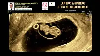 Normal 8-week pregnancy