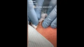 **WHEN PIMPLES SHOOT** HUGE AND EXPLOSIVE Cyst & Pimple Popping Compilation