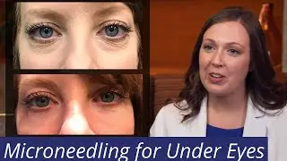 Microneedling Under the Eyes [Alternative to Filler for Dark Circles?] #DarkCircles #Microneedling