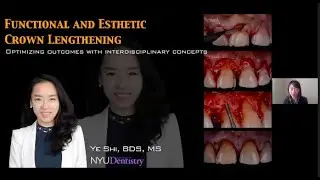 Esthetic Crown Lengthening By  Dr Ye Shi