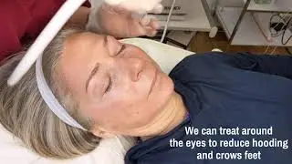 Fractional resurfacing treatment using eTwo Sublative