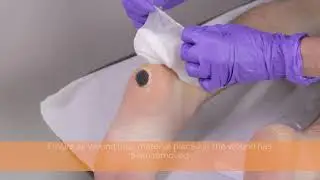 PICO 14 Dressing removal with presence of wound filler