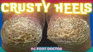 Crusty Heels: Removing Thick Callus and Scales From the Heels