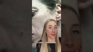 Treating stubborn closed comedones.