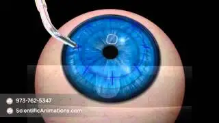 Conductive Keratoplasty Procedure - Ophthalmology Animation