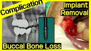 [Online Surgery] Implant remove & re-installation with GBR
