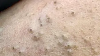 Tranquil Deep Cleansing ASMR — Effective Remedies for Pimple and Blackhead Removal