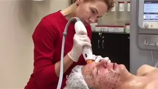 Самая эффективная лифтинговая процедура Термаж