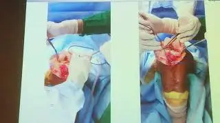 TKR technique