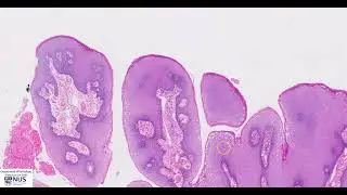 Condyloma (Genital wart) Microscopy - Talking slide