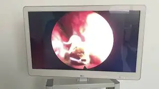 Nasal mucosal granulation tissue