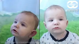 Корректоры для ушей АРИЛИС | избавление от лопоухости | Арилис отзывы