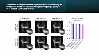 PETALUTE for In Vivo Sodium Content in Human Articular Cartilage at 3T Modified Rosette