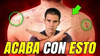 ¡ADIÓS ACNÉ!🧑‍⚕️Los SECRETOS MENOS CONTADOS para MEJORAR en POCOS DÍAS