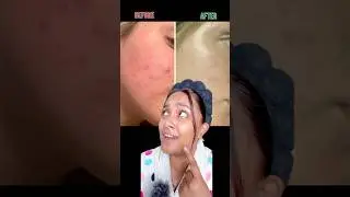 Best solution for Acne and Acne marks ‼️😱#acne #acnetreatment #acnemark #acnescars e