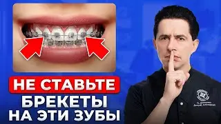 Главная ошибка при установке брекетов. Как сохранить деньги?