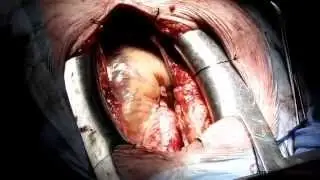 Young women unhealthier than young men prior to first heart attack