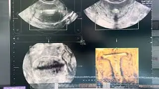 Dispositivo intrauterino. Ultrasonido 4d y 2d