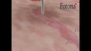 Tratamiento de Estria con laser