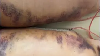 Thigh Lift Surgery PART 2