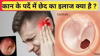 कान के पर्दे में छेद का इलाज क्या है ? Ear drum perforation or ear drum hole treatment