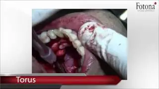 Láseres Fotona - Dental - Aplicaciones generales