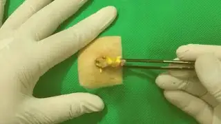 Treatment Of Blackhead Removal at Lam Dep Spa #048