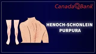 Henoch-Schönlein Purpura (HSP): Rash, Diagnosis & Management | Pediatrics Made Easy | CanadaQBank