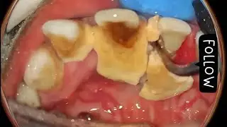 The worst Teeth Cleanings ! Fear of Dentist!