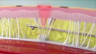 Avéli Cellulite Removal at Harrington Plastic Surgery and SpaVie Medical and Laser Aesthetics