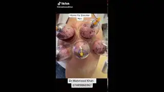 Hijama Cupping Therapy