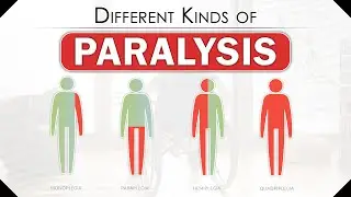Different Kinds of Paralysis | How Does Someone Become Paralyzed | Types of Paralysis | SRIAAS
