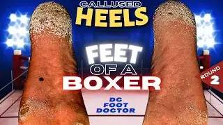 Feet of a Boxer: Knocking Out Painful Calluses, Round 2: The Heels