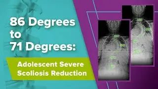 86 Degrees to 71 Degrees: Adolescent Severe Scoliosis Reduction