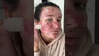 Best Fazit’s Pimple Patch Peels! 