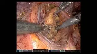 Robot-assisted laparoscopic lateral pelvic lymph node dissection in advanced low rectal cancer