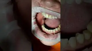 Crowns for dental implants