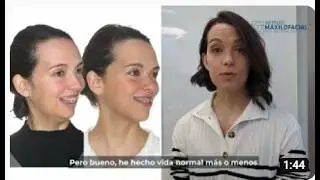 Cirugía bimaxilar Caso #143: Alba - Retrusión maxilo-mandibular, Sonrisa gingival