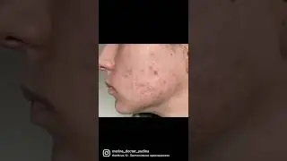 До и После лечения у врача дерматолога,к.м.н., MBA .Юдиной М.М. (instagram  @marina_doctor_yudina  )