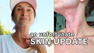 SKIN UPDATE: Feeling Discouraged // Topical Steroid Withdrawal & Eczema