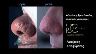 Ρινοφυμα, αφαίρεση με LASER