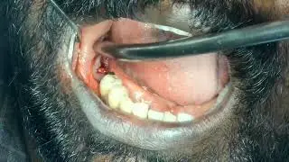part 1 - combination of redice and norris compressive implants for lower molars - immediate loading