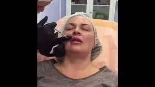 Контурная пластика губ