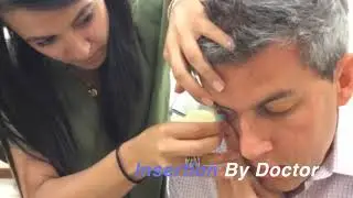 Instructional Video: Contact Lens Insertion and Removal: Scleral Lens
