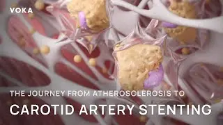 The journey from atherosclerosis to carotid artery stenting